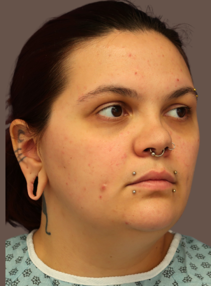 VASER Liposuction Before & After Patient #9210