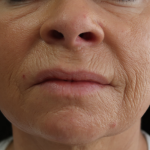 Microneedling with V Hacker Before & After Patient #9196