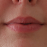 Bacio Lips Before & After Patient #9189