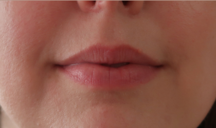 Bacio Lips Before & After Patient #9189