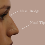 Non-Surgical Rhinoplasty Before & After Patient #9197