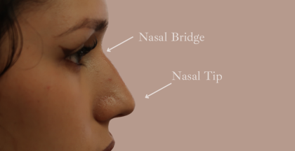 Non-Surgical Rhinoplasty Before & After Patient #9197