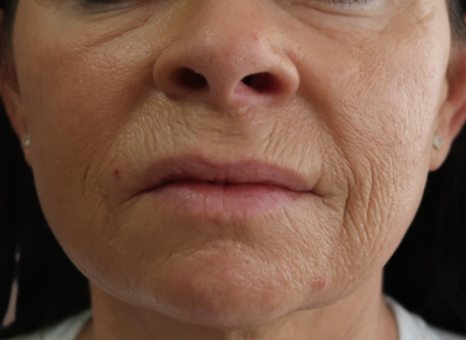 Microneedling with V Hacker Before & After Patient #9196