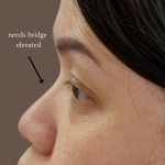 PDO Threads Before & After Patient #9199