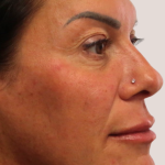 Sapphire Before & After Patient #9201