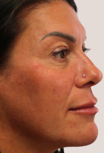 Sapphire Before & After Patient #9201