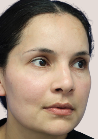 Sapphire Before & After Patient #9202