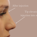 Non-Surgical Rhinoplasty Before & After Patient #9197
