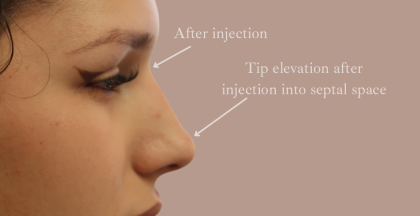 Non-Surgical Rhinoplasty Before & After Patient #9197