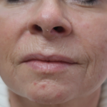 Microneedling with V Hacker Before & After Patient #9196