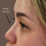 PDO Threads Before & After Patient #9199
