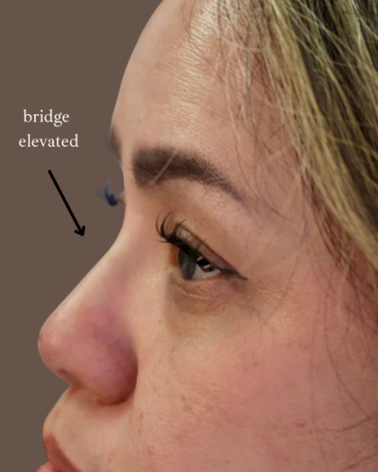 PDO Threads Before & After Patient #9199