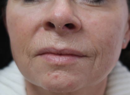 Microneedling with V Hacker Before & After Patient #9196