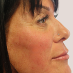 Sapphire Before & After Patient #9201