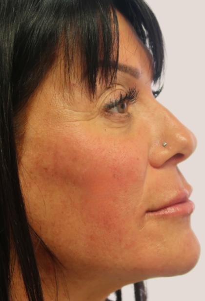 Sapphire Before & After Patient #9201