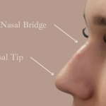 Non-Surgical Rhinoplasty Before & After Patient #9197