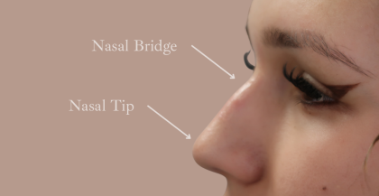 Non-Surgical Rhinoplasty Before & After Patient #9197