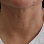 Microneedling with V Hacker Before & After Patient #9196