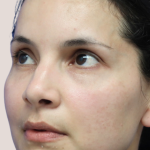 Sapphire Before & After Patient #9202