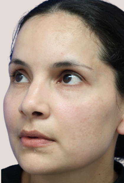 Sapphire Before & After Patient #9202