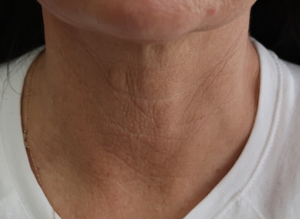 Microneedling with V Hacker Before & After Patient #9196
