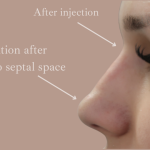 Non-Surgical Rhinoplasty Before & After Patient #9197