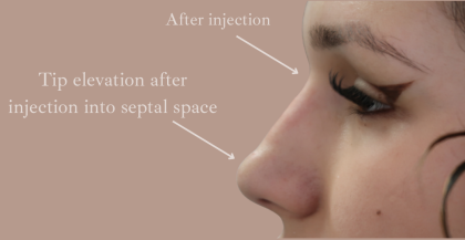 Non-Surgical Rhinoplasty Before & After Patient #9197