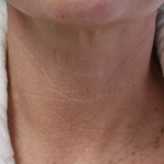 Microneedling with V Hacker Before & After Patient #9196
