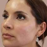 Sapphire Before & After Patient #9203
