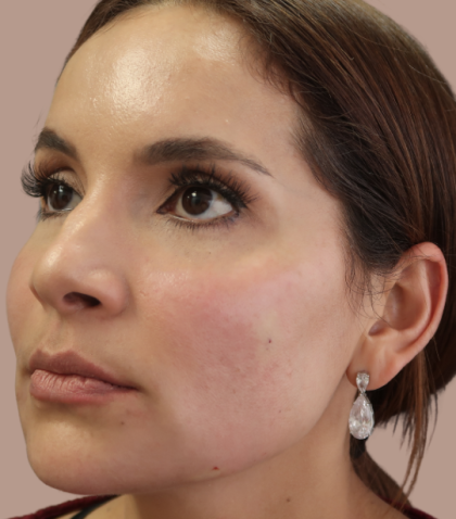 Sapphire Before & After Patient #9203
