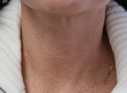 Microneedling with V Hacker Before & After Patient #9196
