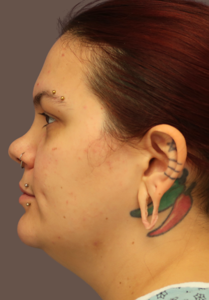 VASER Liposuction Before & After Patient #9210