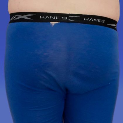 Liposuction Before & After Patient #9381