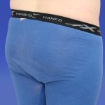 Liposuction Before & After Patient #9381
