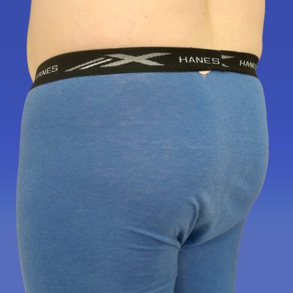 Liposuction Before & After Patient #9381