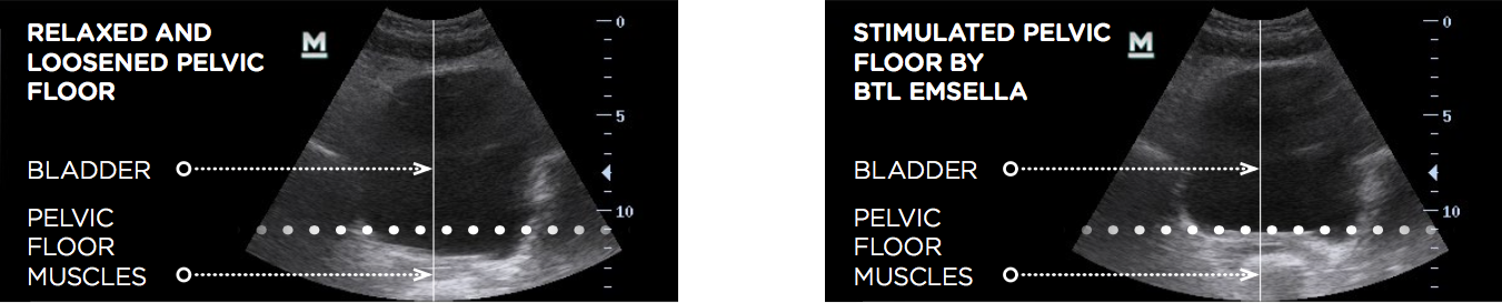 emsella ultrasound